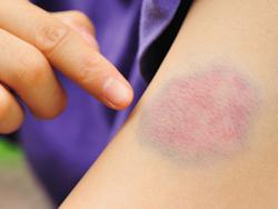 bruise jelentese magyarul